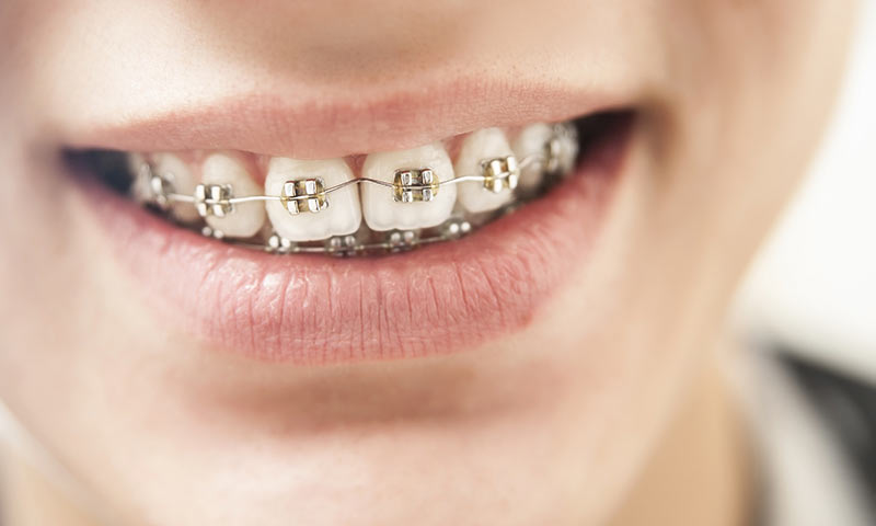 Brackets